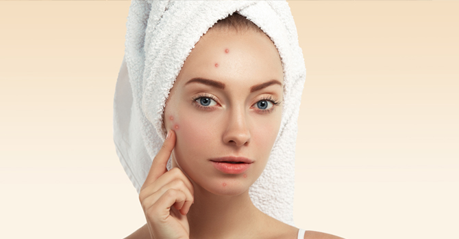 لن تتوقعي أن هذا المستحضر ينهي كابوس حب الشباب