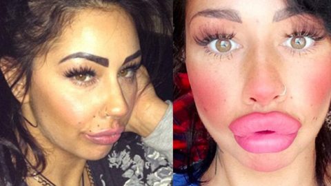 إمرأة تتحول إلى سمك السلمون بفيلر الشفاه.. فلماذا فعلت ذلك؟