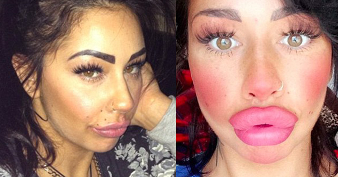 إمرأة تتحول إلى سمك السلمون بفيلر الشفاه.. فلماذا فعلت ذلك؟