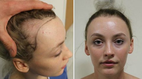 راقصة باليه تفقد شعرها بسبب تصفيفة الكعكة