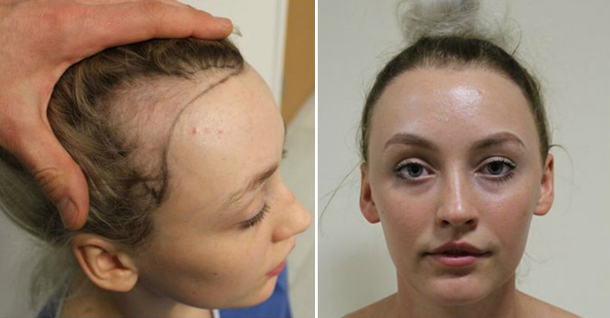 راقصة باليه تفقد شعرها بسبب تصفيفة الكعكة