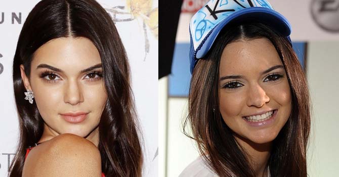 ماذا فعلت كيندال جينر لتتخلص من حب الشباب؟