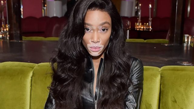 نجمات أصبن بالبهاق في وسط مسيرتهم الفنية تعرفي إليهم