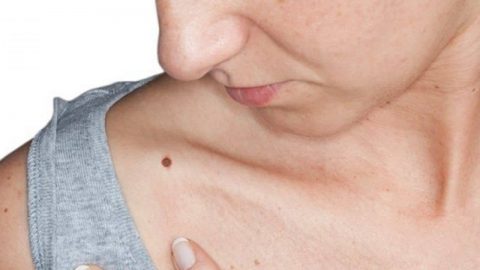 شامات جديدة في الجسم: هل الأسباب سرطانية؟