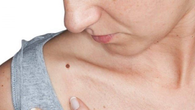 شامات جديدة في الجسم: هل الأسباب سرطانية؟