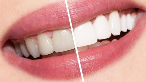 أفضل الوصفات لتبييض الأسنان لا تنسي تطبيقها
