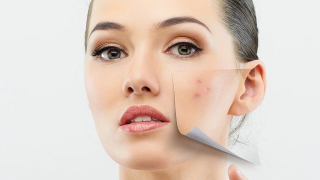 هل تعانين من مشكلة الحبوب تحت الجلد؟ إليك الحل