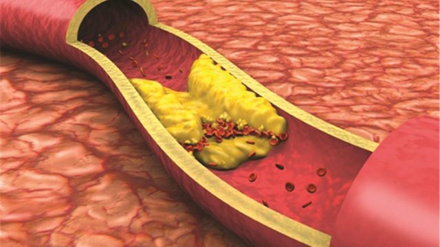 4 أعراض لارتفاع الكولسترول الضار في الدم!