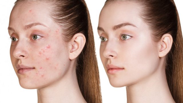 كيف تتخلصين من النقط البنية على الوجه بطرق طبيعية؟