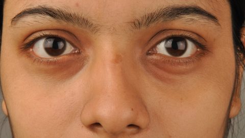 علاج انتفاخ العين : تورم الجفون وهالات سوداء وأمور أخرى