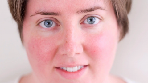 كيف تعالجين بشرتك من الاحمرار؟ إليك الطريقة