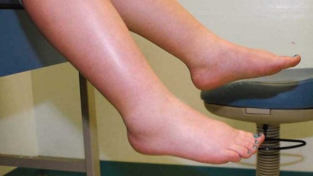 اكتشفي معنا أهم أسباب احتباس الماء أثناء فترة الحمل