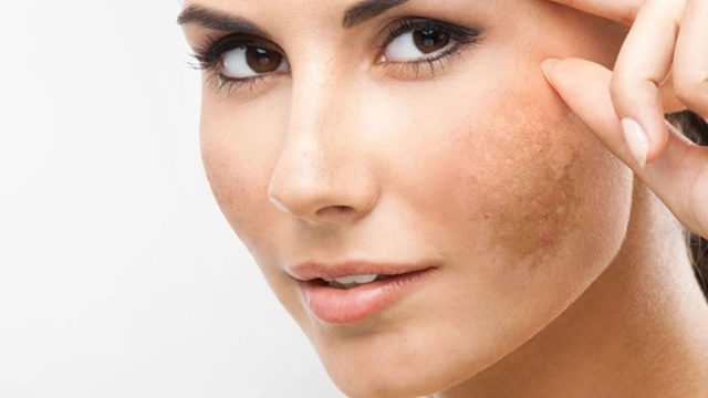 اصنعي كريم تبييض من زبدة الشيا لعلاج الكلف والبقع الداكنة