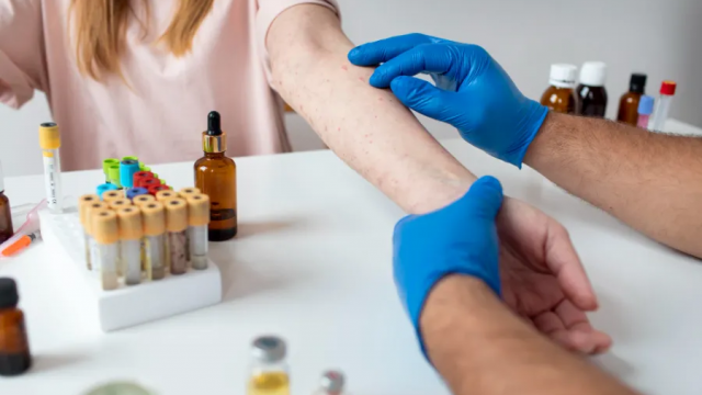 الذئبة الحمراء : الأعراض وطرق العلاج